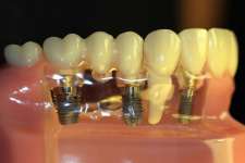 dental Implant tooth