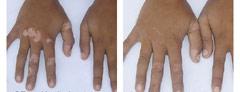 Herbal remedy for Re-pigmentation Of Vitiligo / Lecuderma
