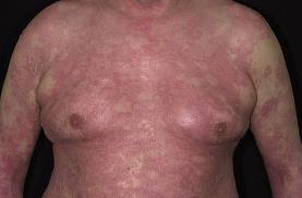 DRUG FOR TREATMENT OF DISEASES Psoriasis