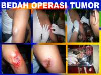 ATASI BERBAGAI MACAM PENYAKIT TUMOR / KANKER ,  LUMPUH ,  KENCING MANIS ,  URAT SYARAF DLL