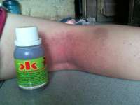 DRUG FOR TREATMENT OF DISEASES Psoriasis