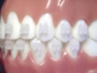 orthodontic-brackets